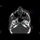 Fracture of orbital floor, tear-drop figure, hemosinus: CT - Computed tomography